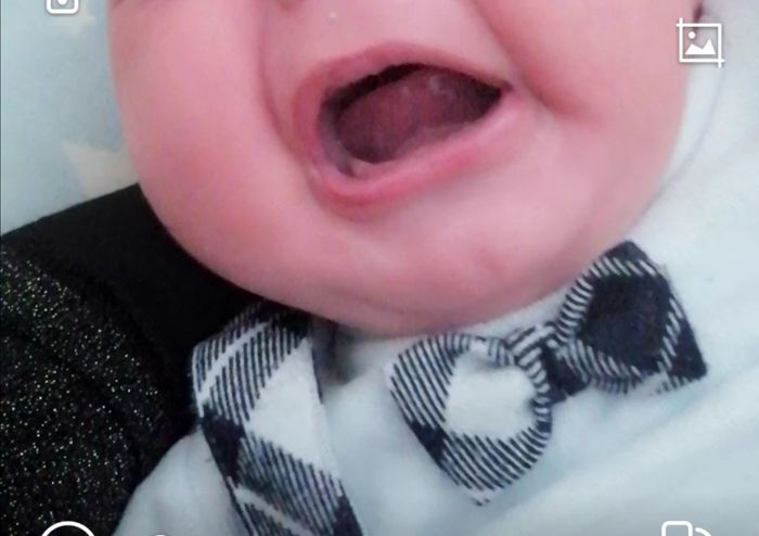 Frenulo linguale Corto? 2