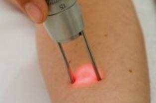 Epilazione permanente laser