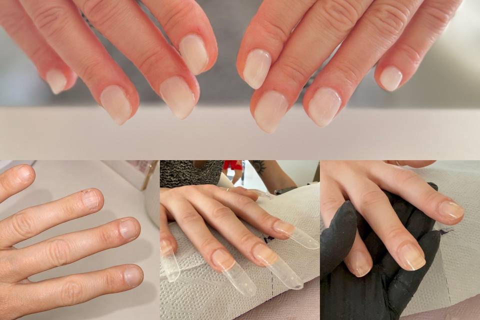 Ricostruzione sposa onicofagia