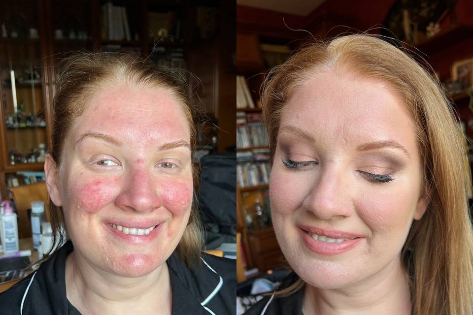 Prima&dopo correzione rosacea
