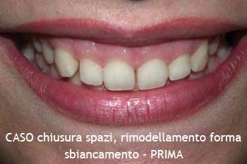Chiusura degli spazi e rimodellamento denti - PRIMA