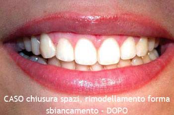 Chiusura degli spazi e rimodellamento denti - DOPO