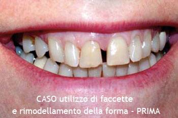 Utilizzo di faccette e rimodellamento della forma dei denti- PRIMA