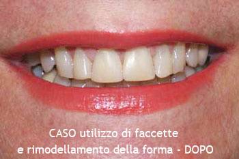 Utilizzo di faccette e rimodellamento della forma dei denti - DOPO