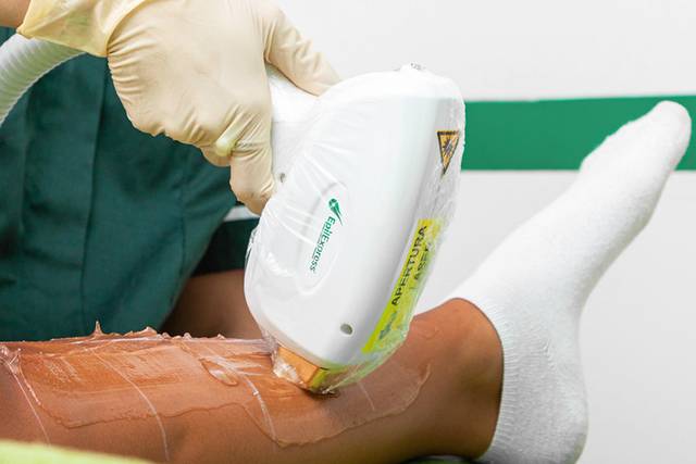 Trattamento epilazione laser