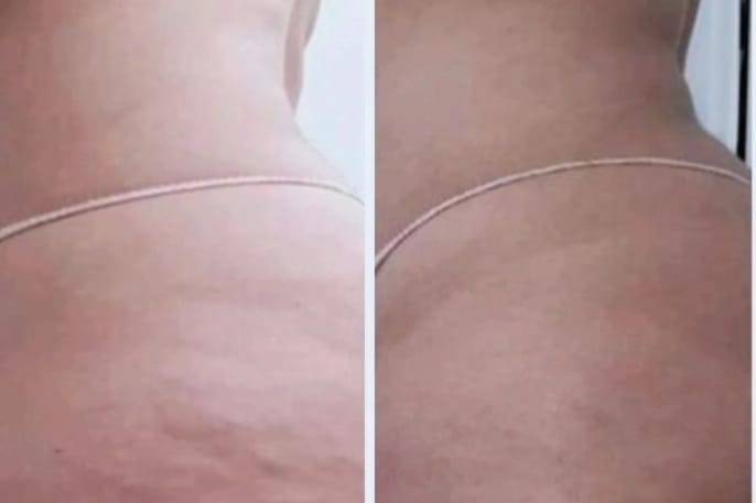 Cellulite fibroscelrotica