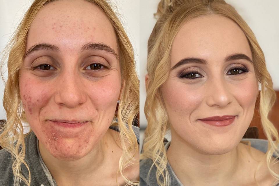 Makeup su acne