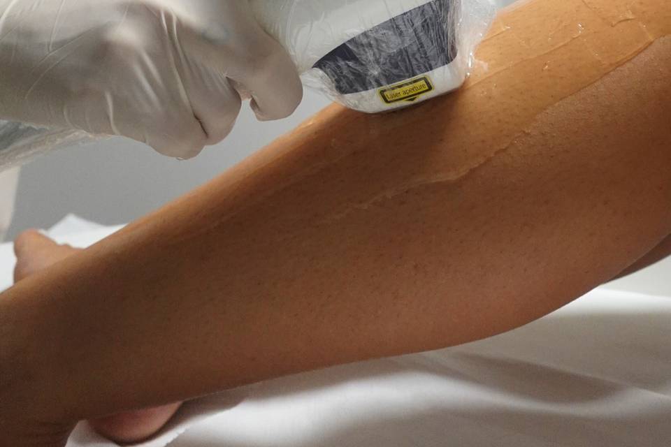 Epilazione professionale laser