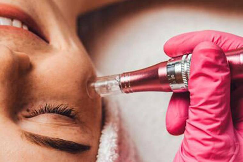 Microneedling